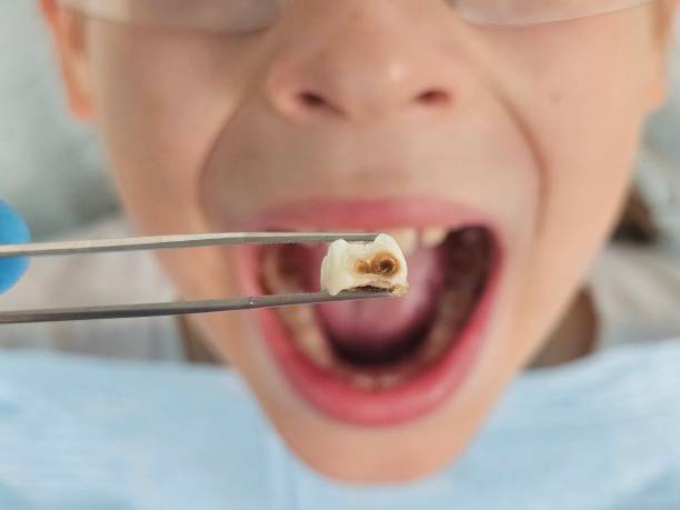 Best Emergency Tooth Extraction in Hazen, AR